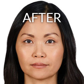 before after photos kybella