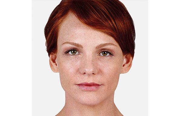 Juvederm Before & After Patient #186