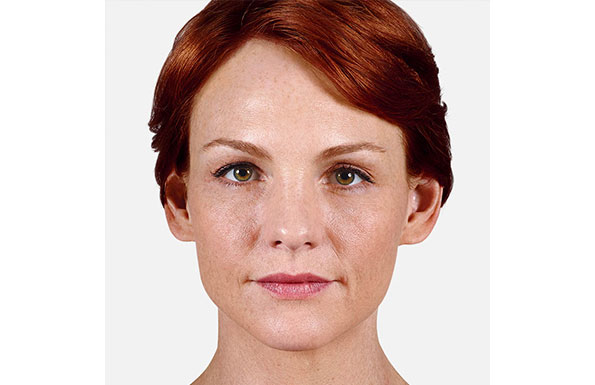 Juvederm Before & After Patient #186