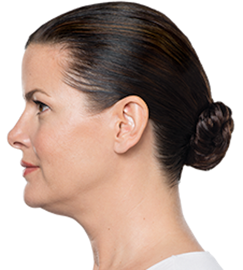 Kybella Before & After Patient #226
