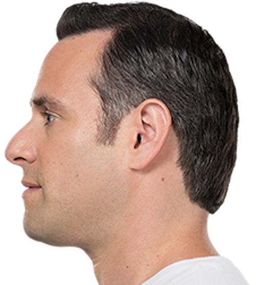 Kybella Before & After Patient #229