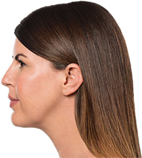 Kybella Before & After Patient #232