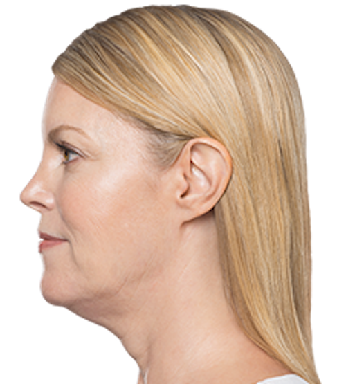 Kybella Before & After Patient #235
